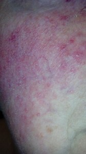 rosacea close up_n