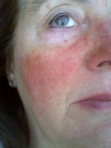 rosacea21_n